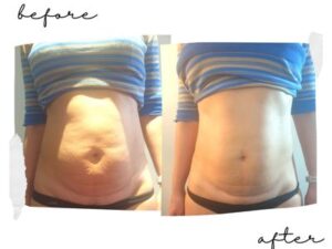 before and after csection massage