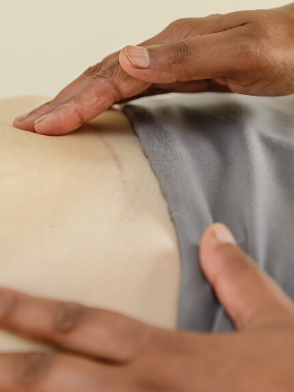 Scar Therapy